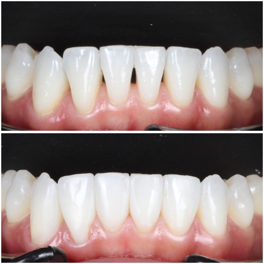 Bioclear Black Triangle Closure