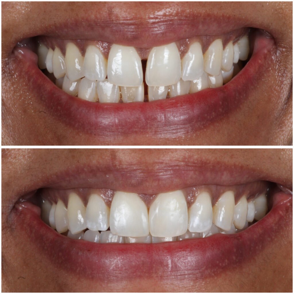 Bioclear Space Closure