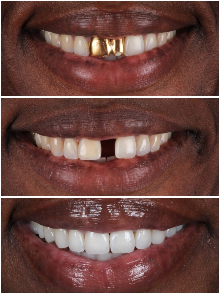 Gold Crown Replacement