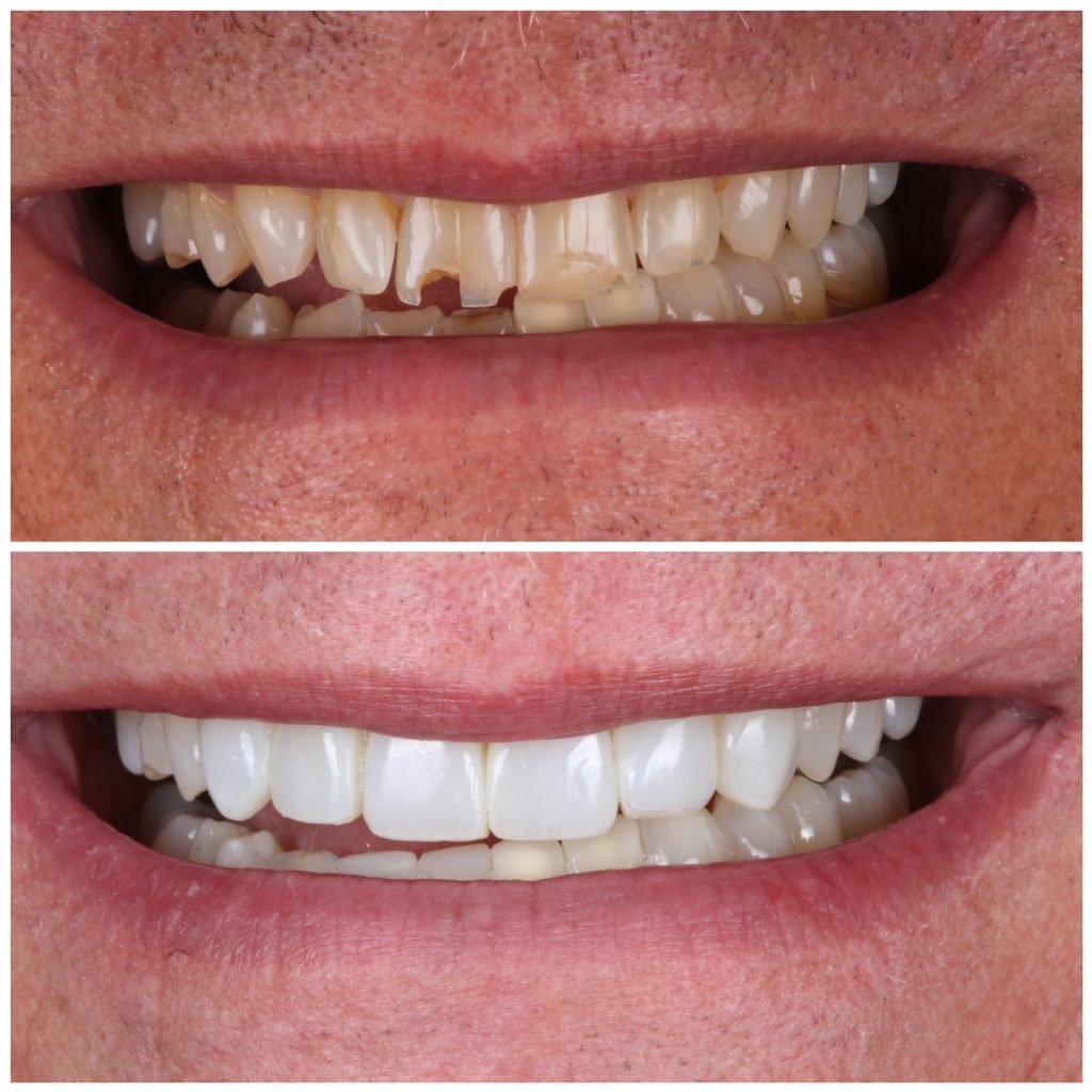 Highlight Composite Veneers