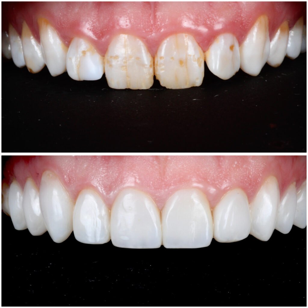 Highlight Composite Veneers