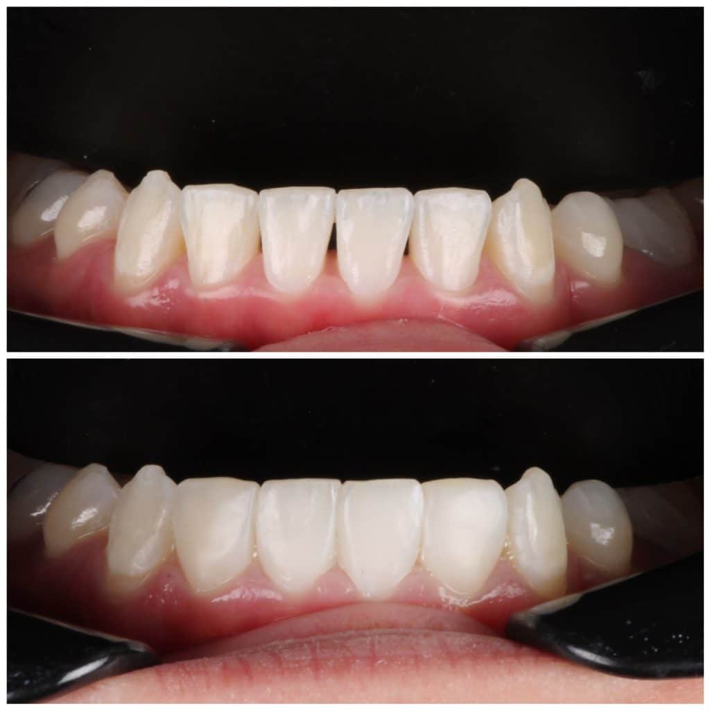 Black Triangles on lower teeth