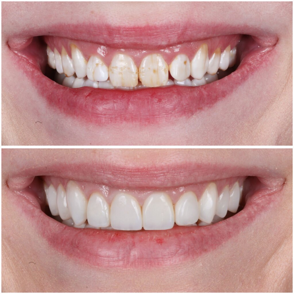 Highlight Composite Veneers
