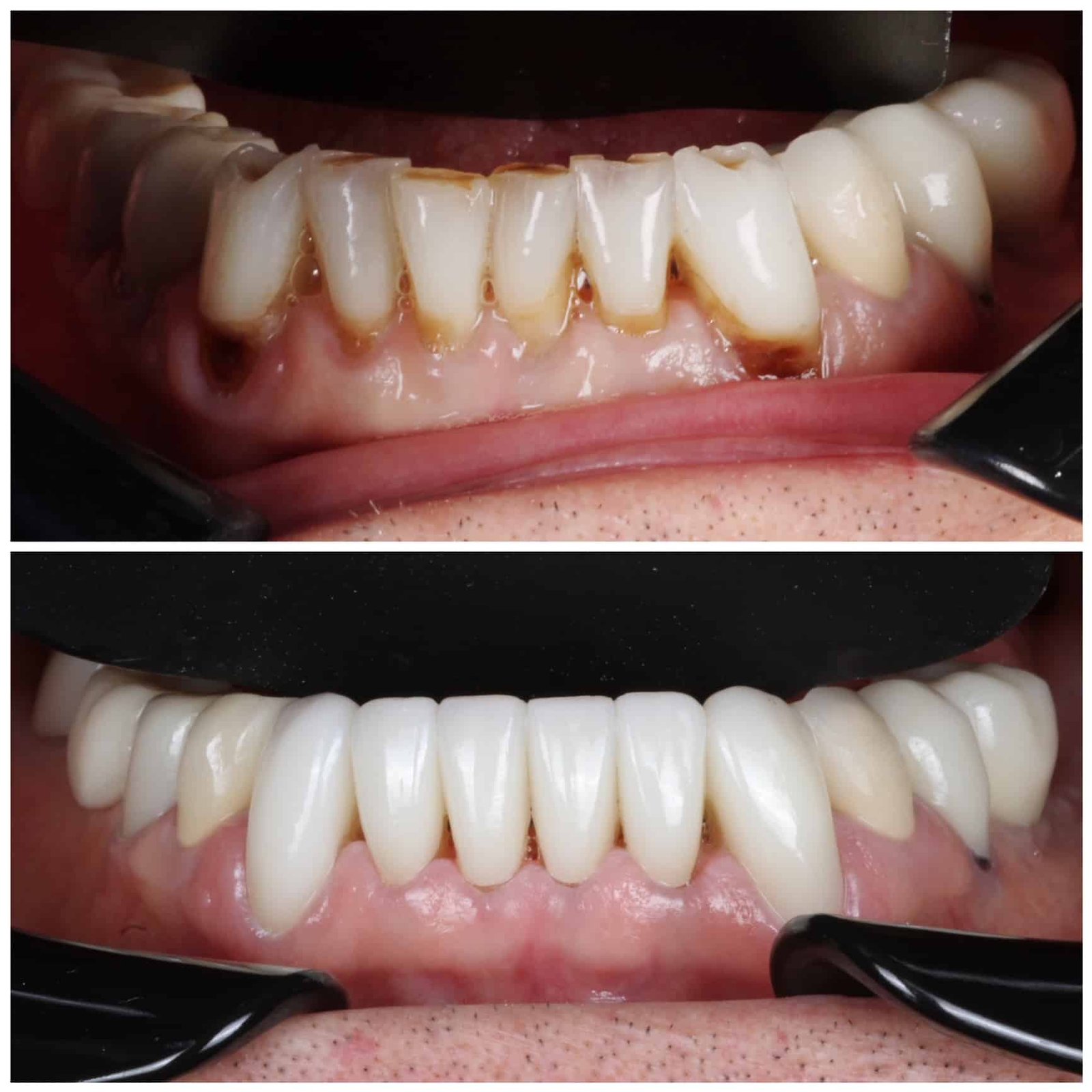 lower teeth smile rehab