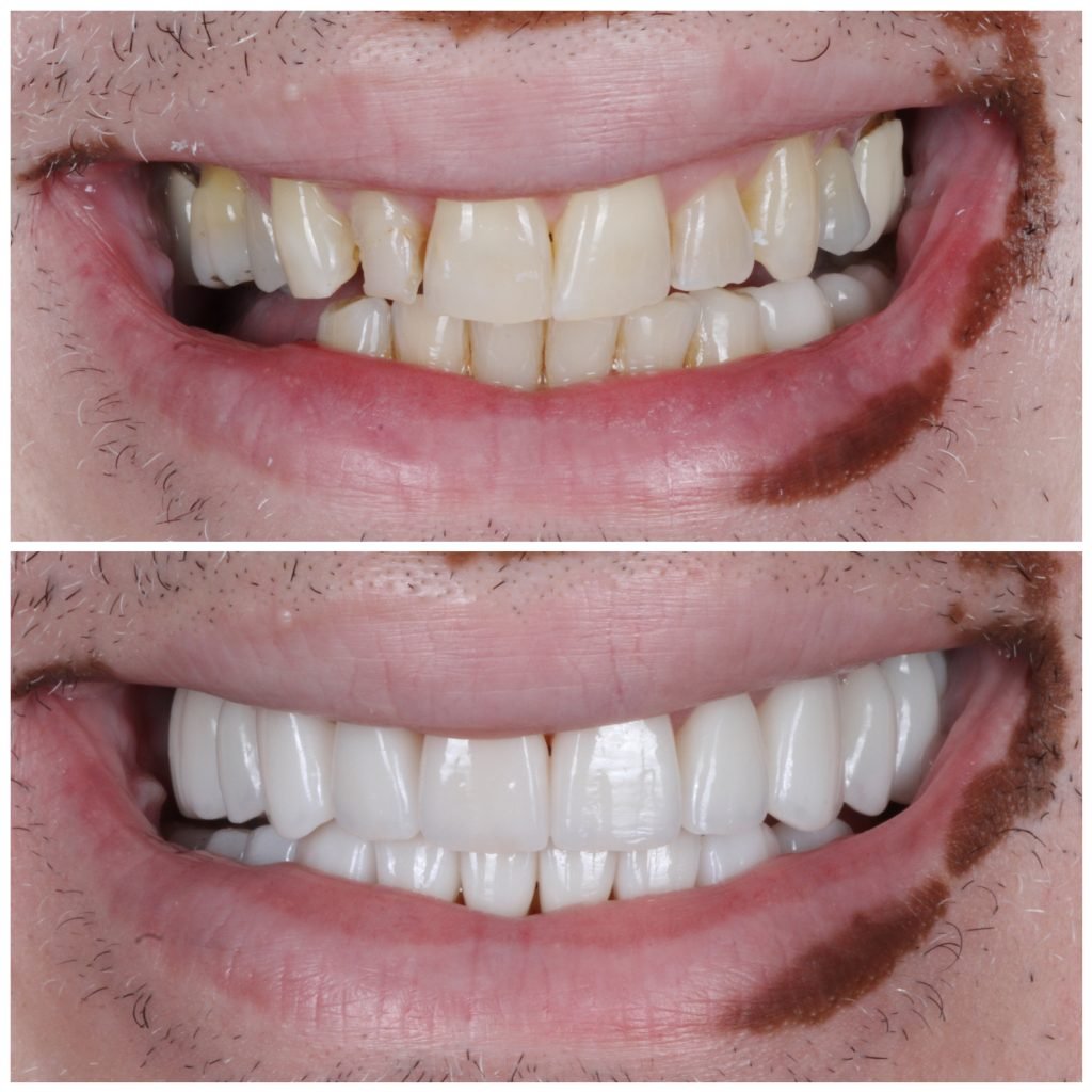 Full Mouth Reconstruction with porcelain veneers and crowns
