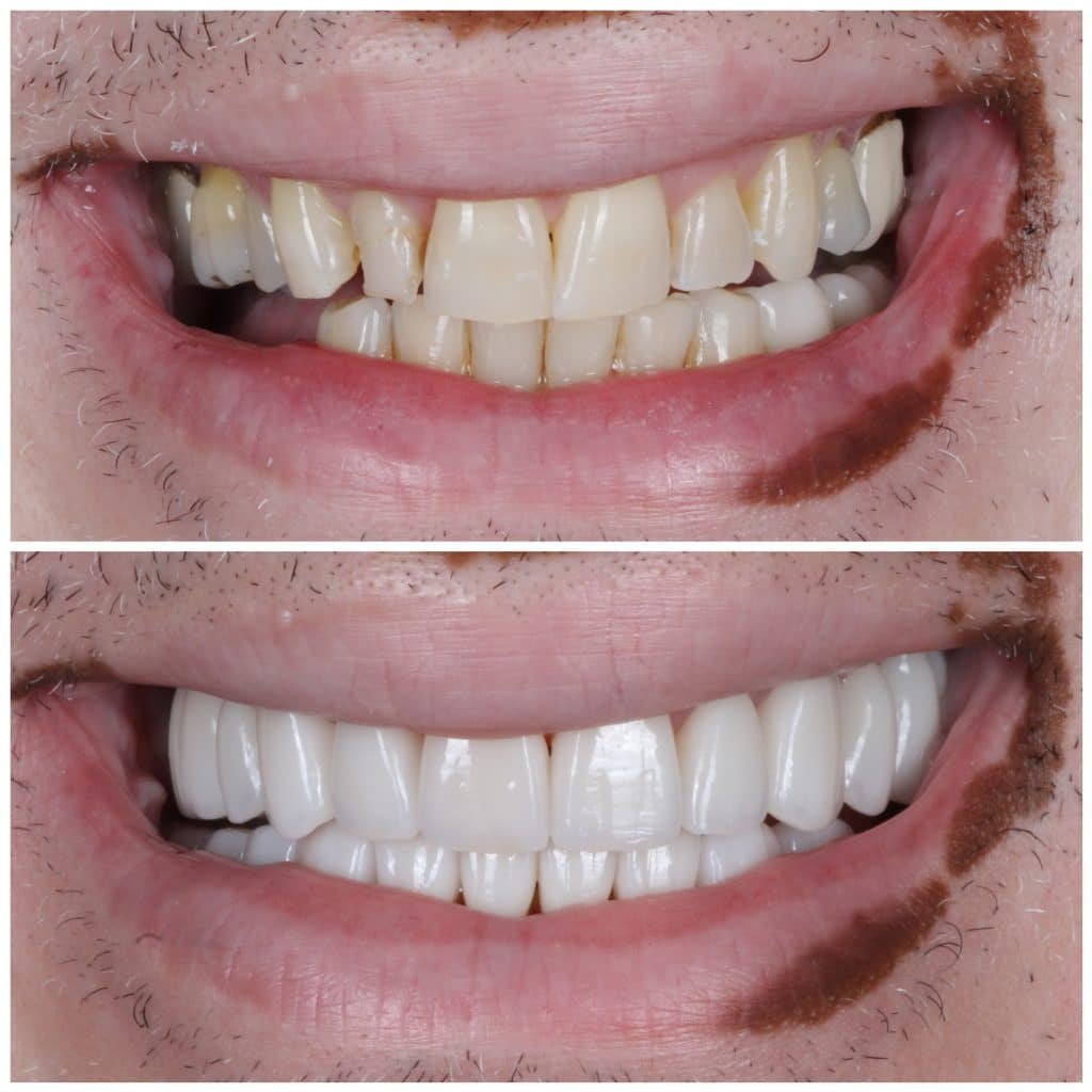 Full Mouth Rehab - Smile Makeover Porcelain Veneers