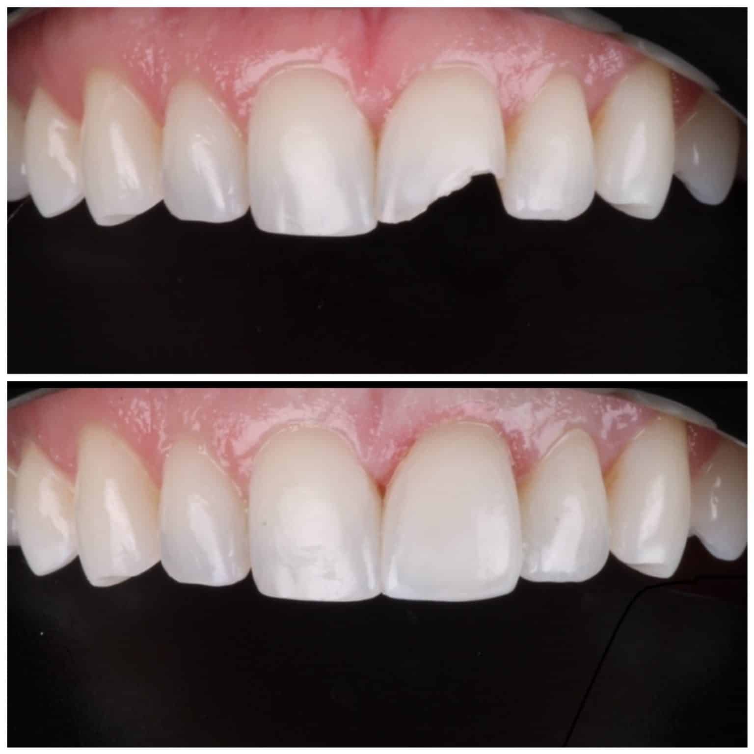 Composite Veneers | Highlight Veneers #1 Cosmetic Dentist