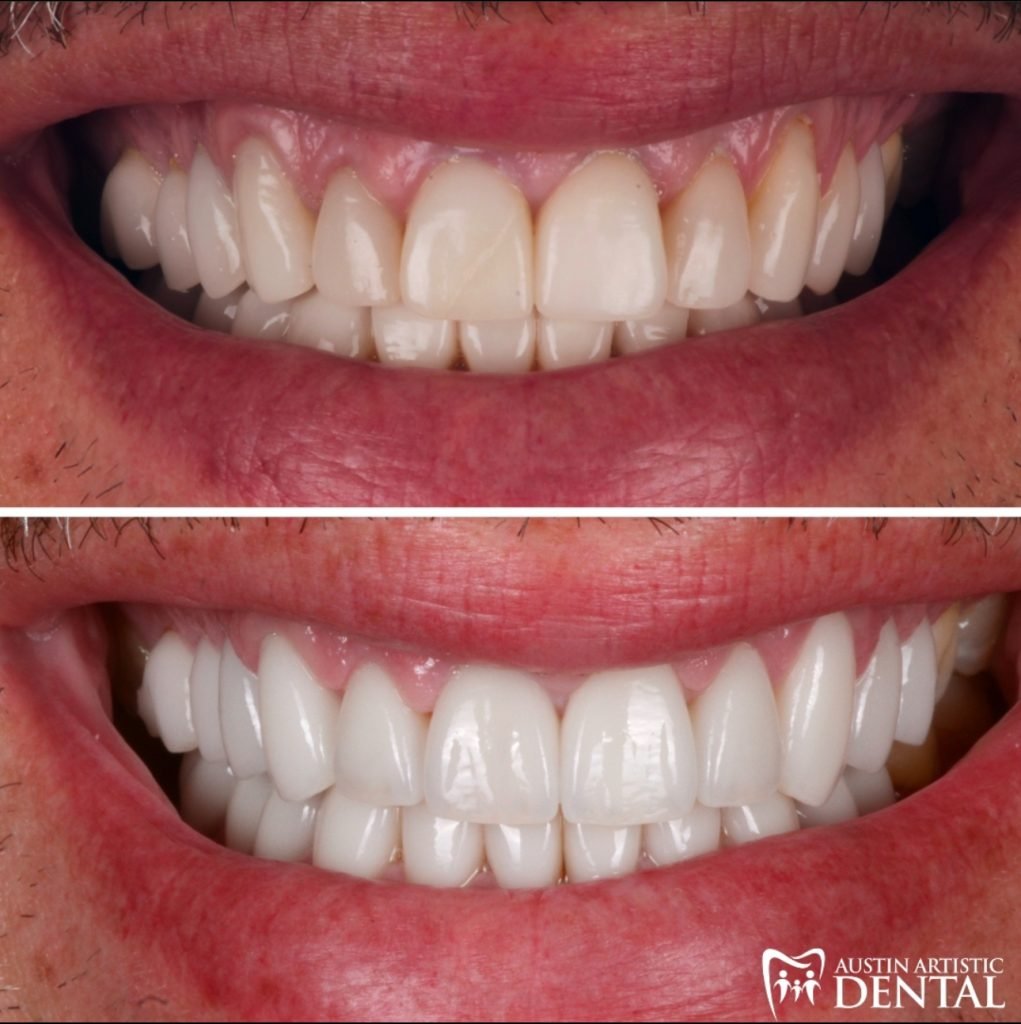 Full mouth rehabilitation