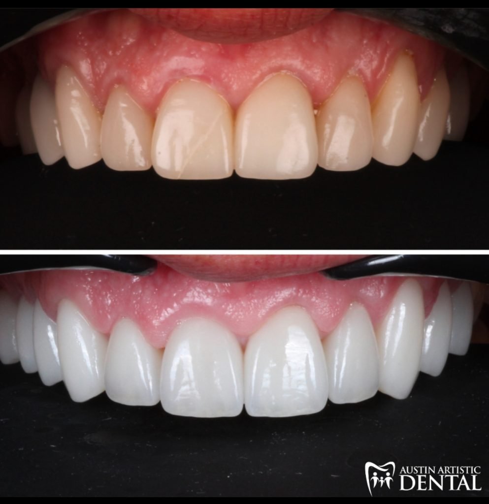 Full mouth rehabilitation