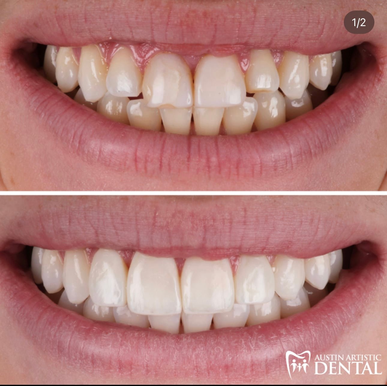 Composite Veneers for a teenager