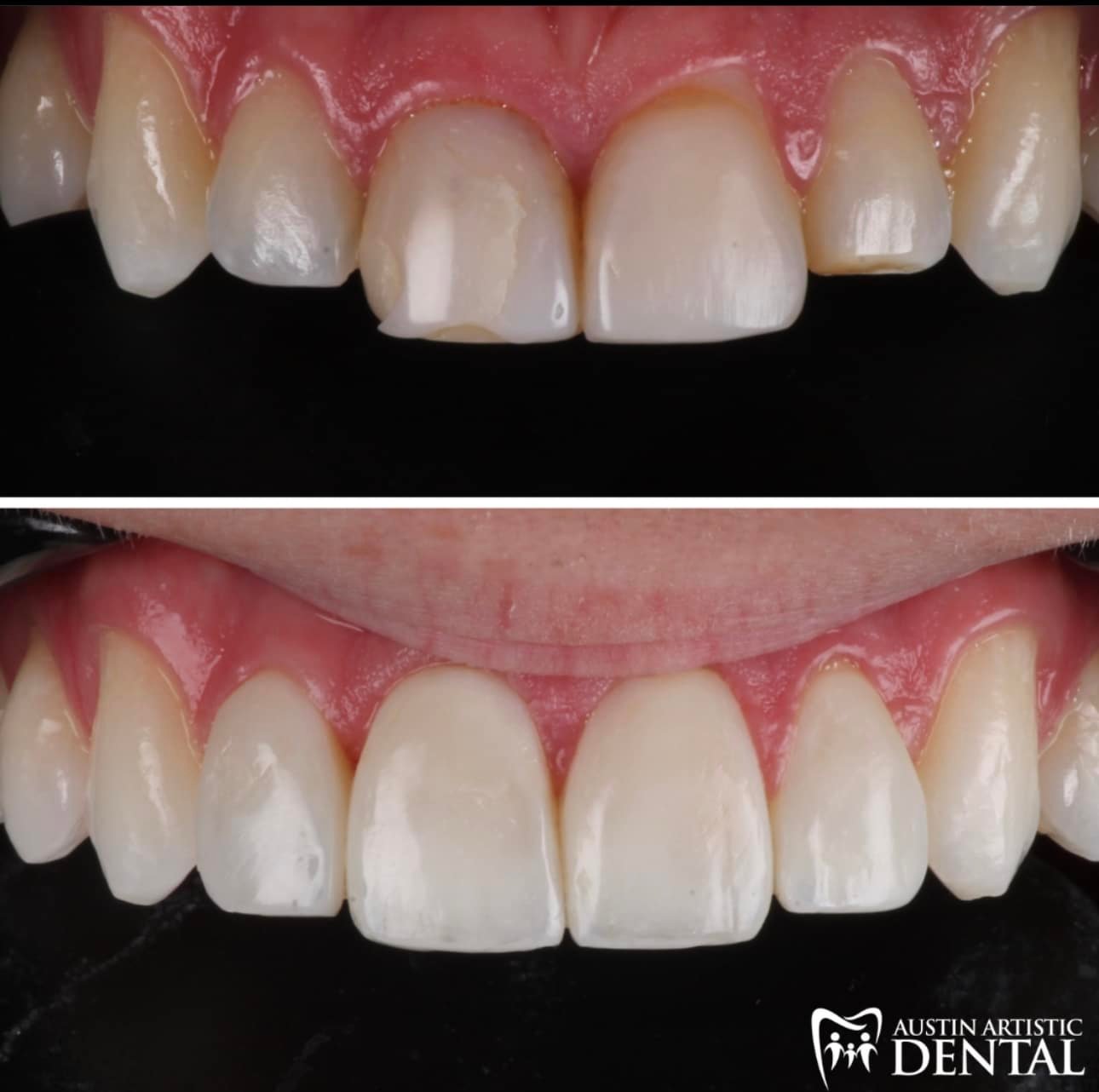 Composite Veneers for a teenager