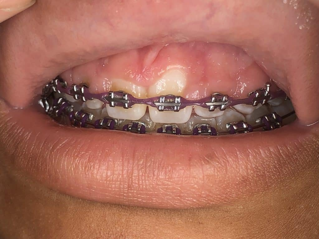 Puffy gums from braces