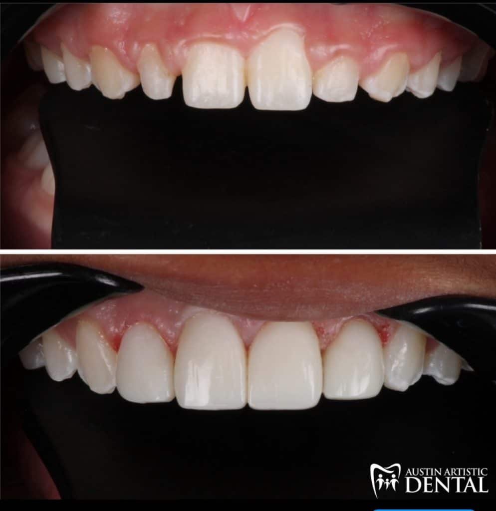 Bioclear Composite Veneers fixing peg laterals