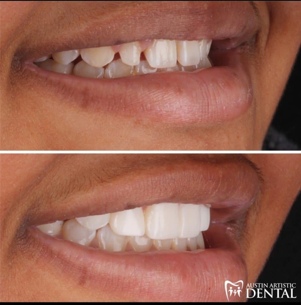 Peg Lateral fixed with Bioclear Composite Veneers