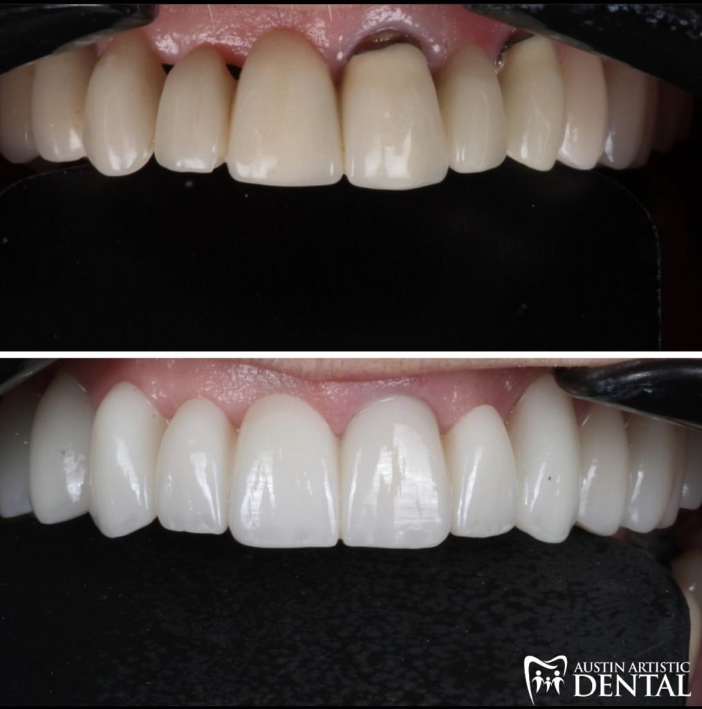 Natural Looking Porcelain Veneers and bridges