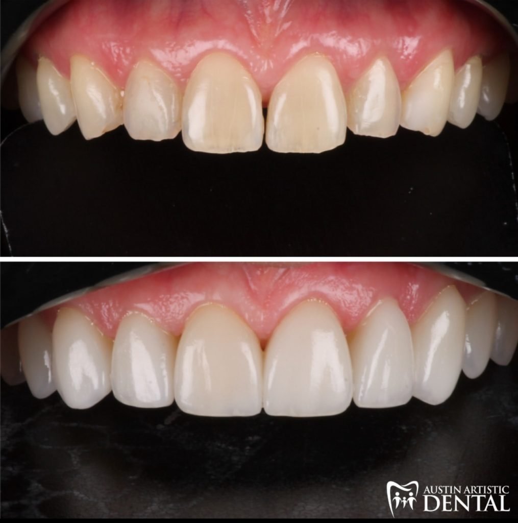 Natural Looking Porcelain Veneers