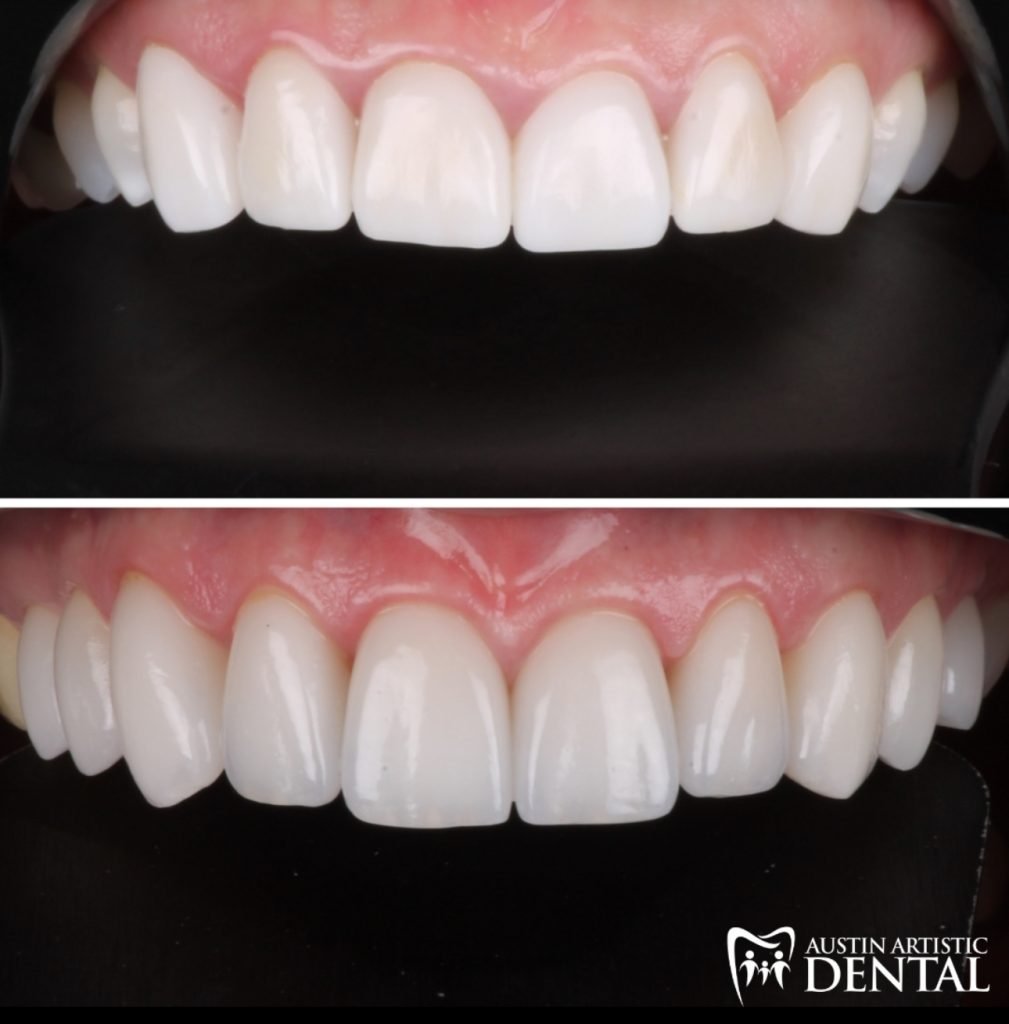 Natural Looking Porcelain Veneers