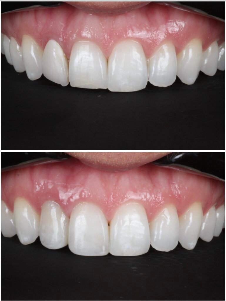 Broken porcelain veneer replaced with composite veneers