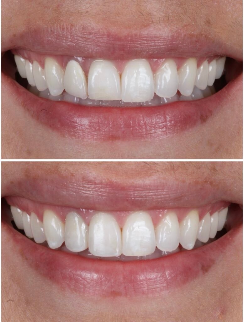 Broken porcelain veneer replaced with composite veneers