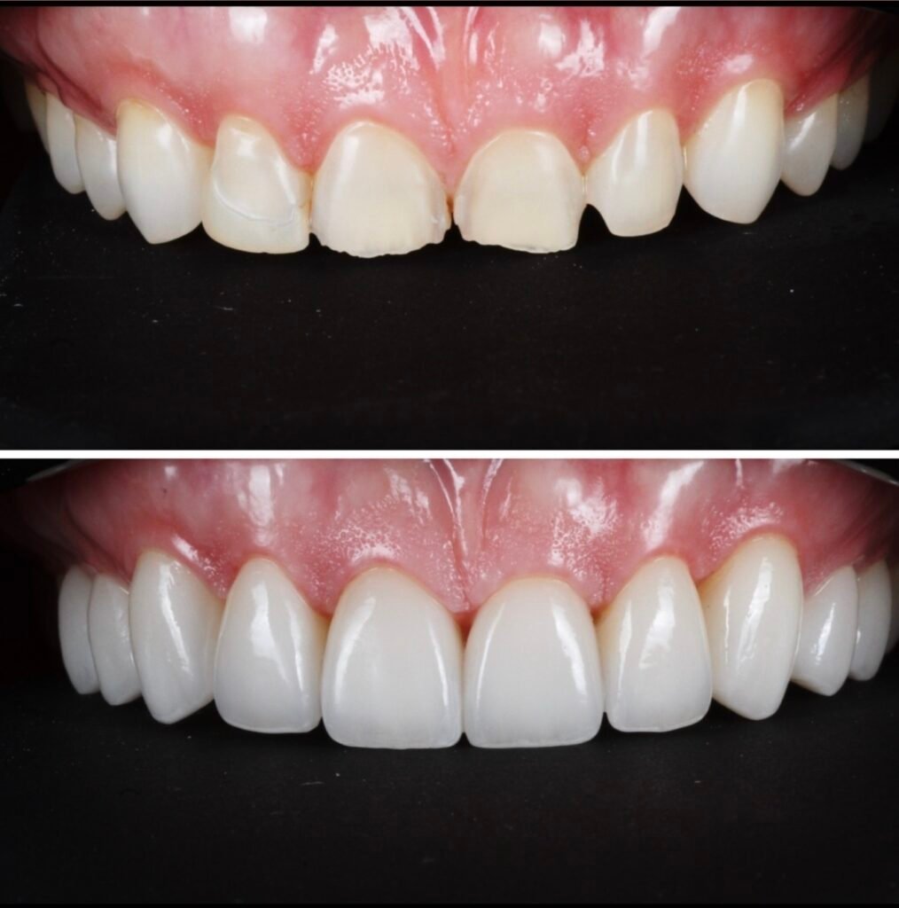 Porcelain Veneer Smile Makeover