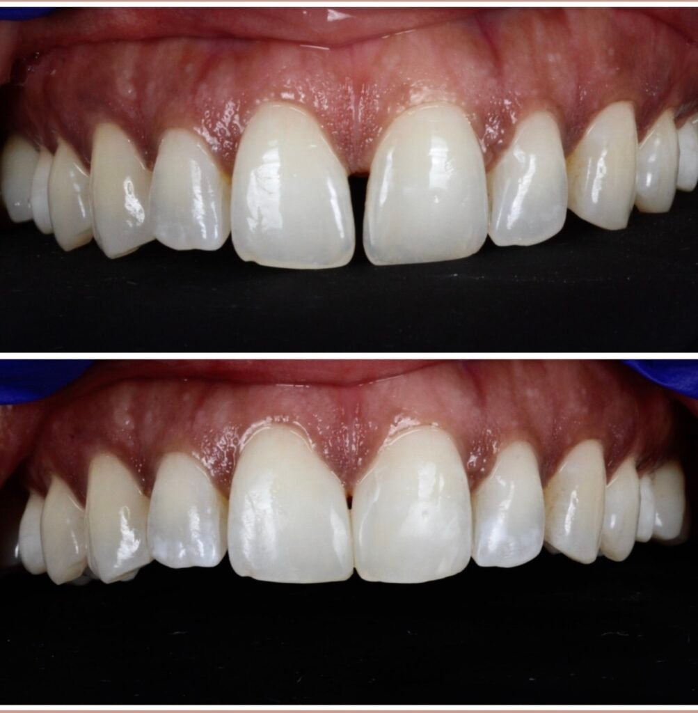 Bioclear Space Closure