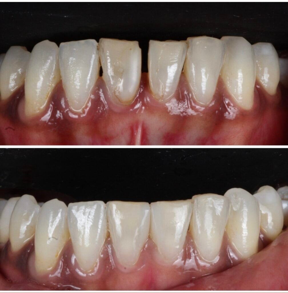 Bioclear Diastema Closure