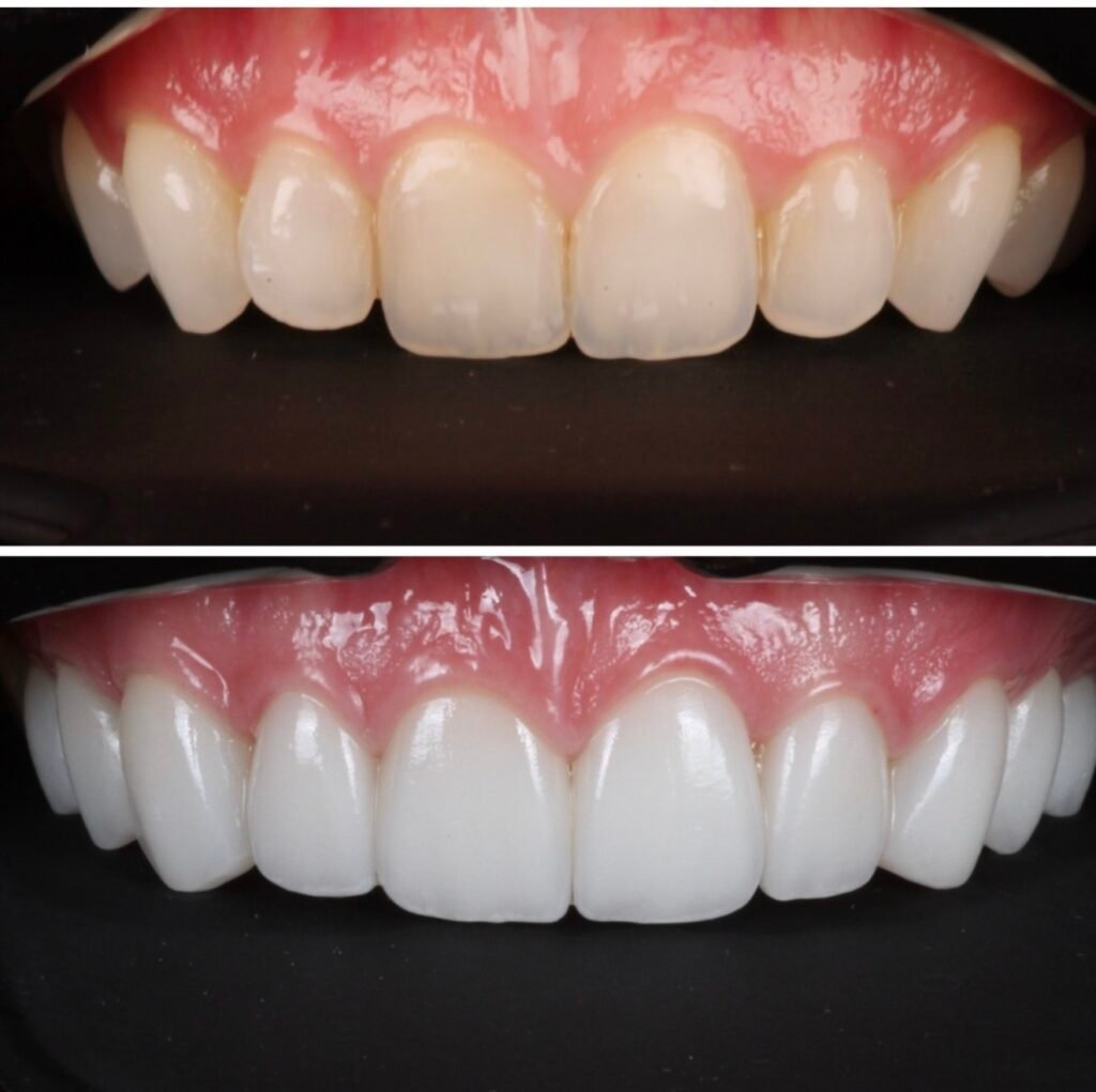 Perfect Smile Makeover