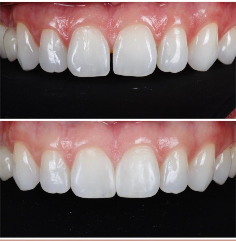 Bioclear Gap Closure