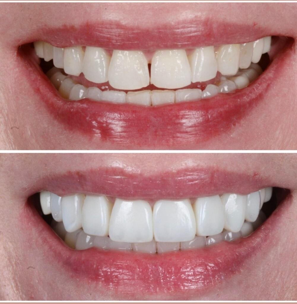 Smile Makeover with Composite Veneers