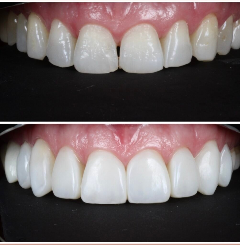 Highlight Composite Veneers