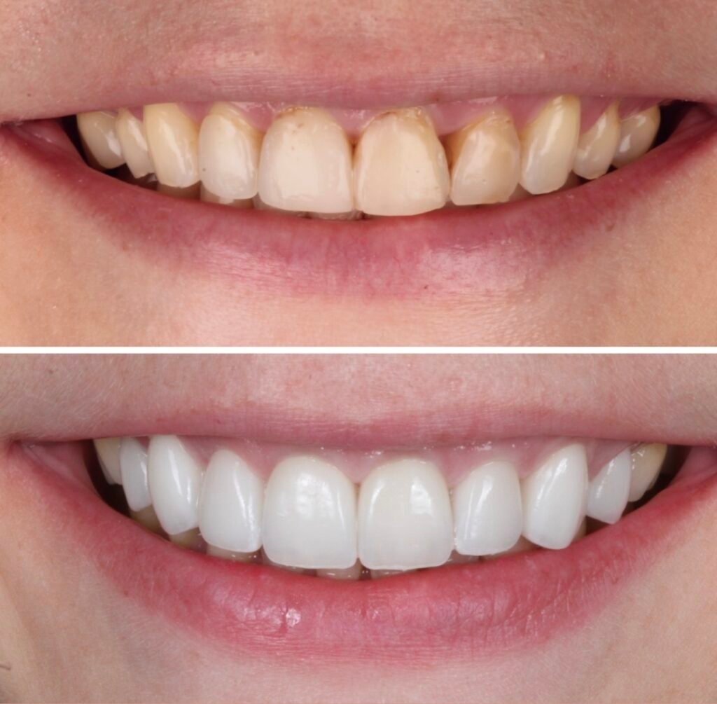 Porcelain Veneers Smile Makeover