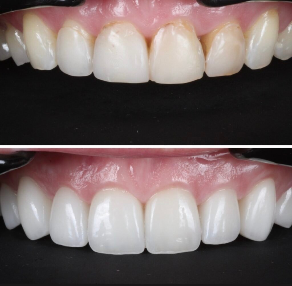 Porcelain Veneers Smile Makeover