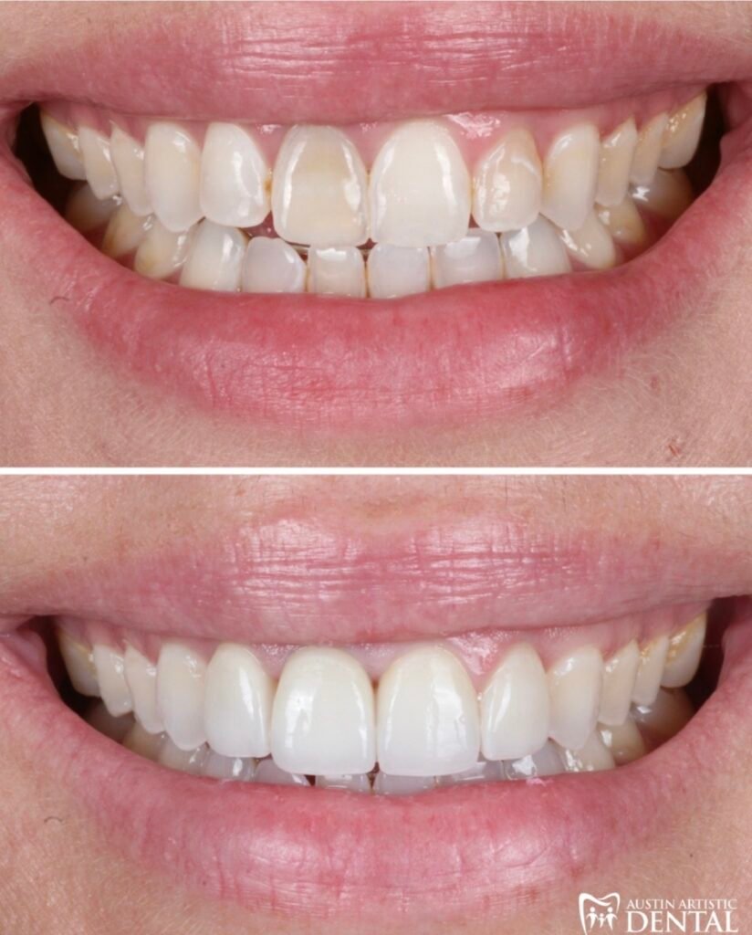 porcelain veneers to cover up dark teeth