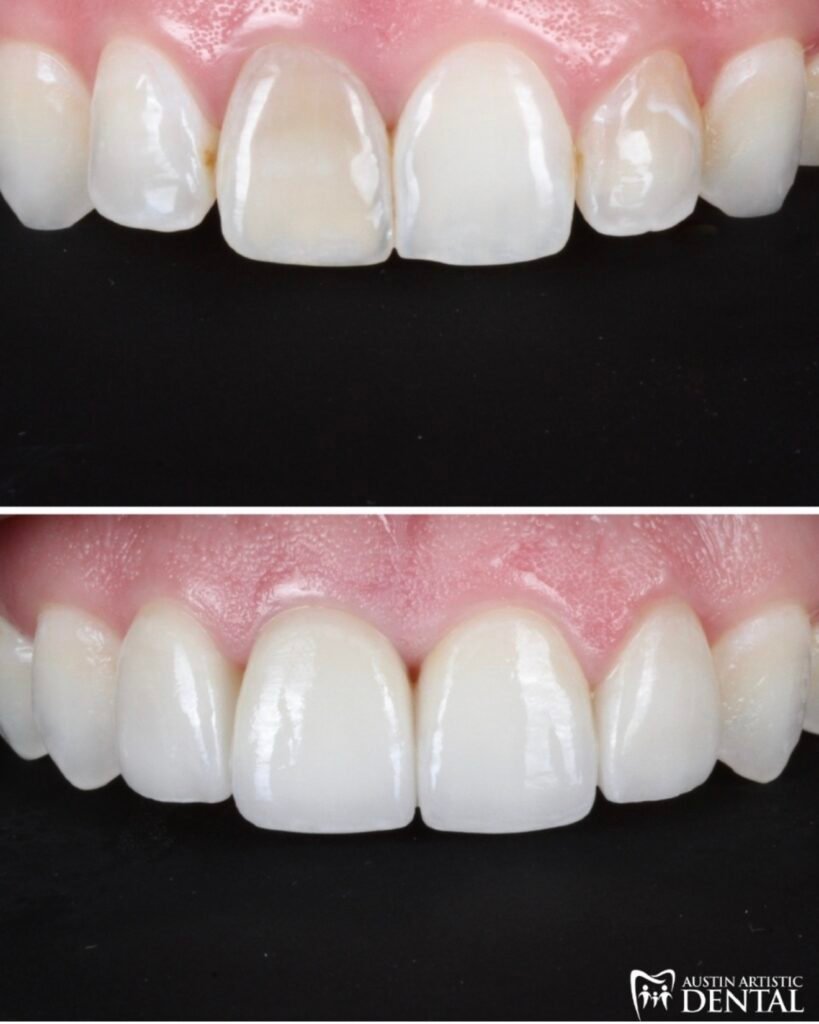 porcelain veneers to cover up dark teeth