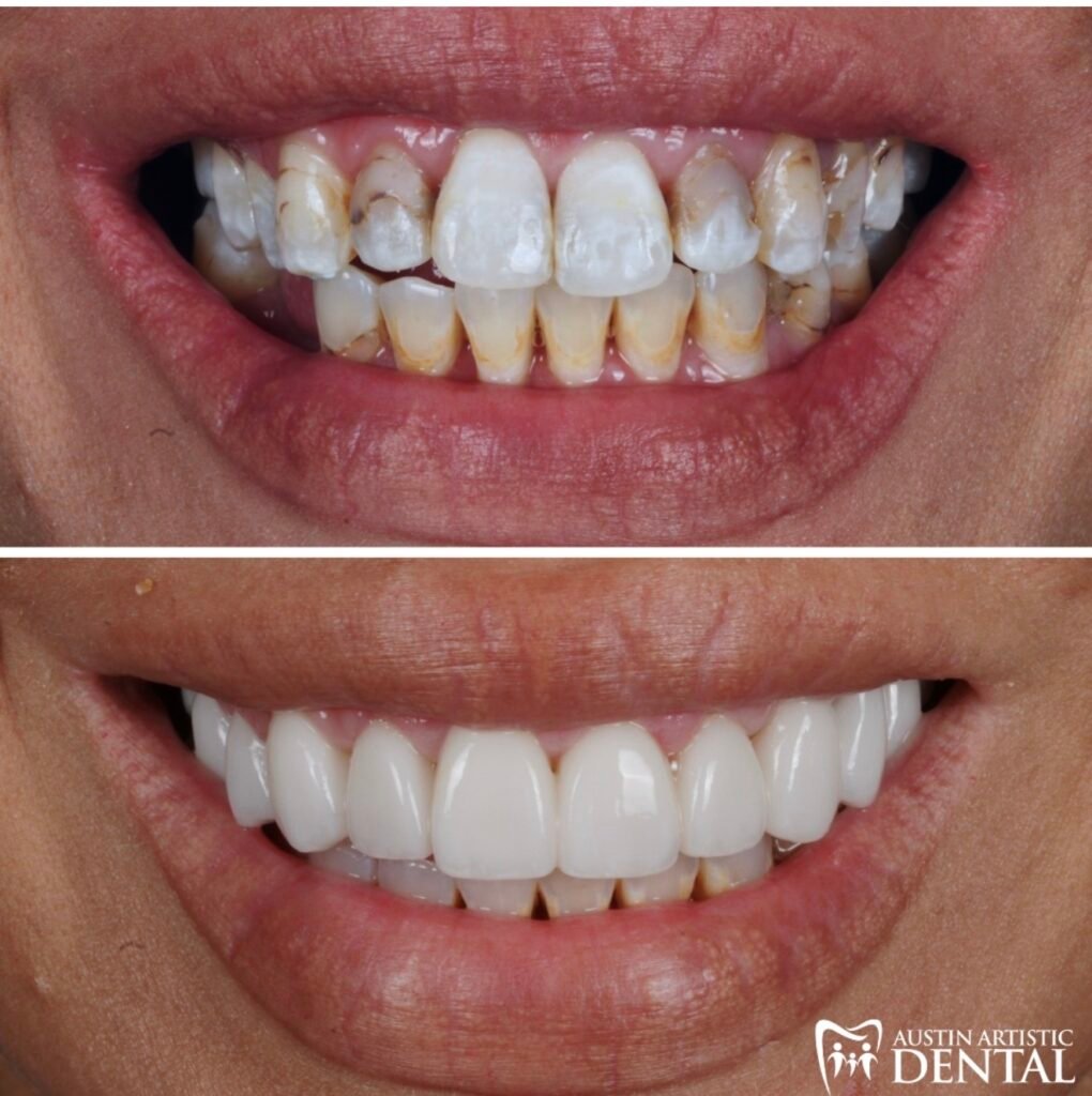 Porcelain Veneers to restore large cavities