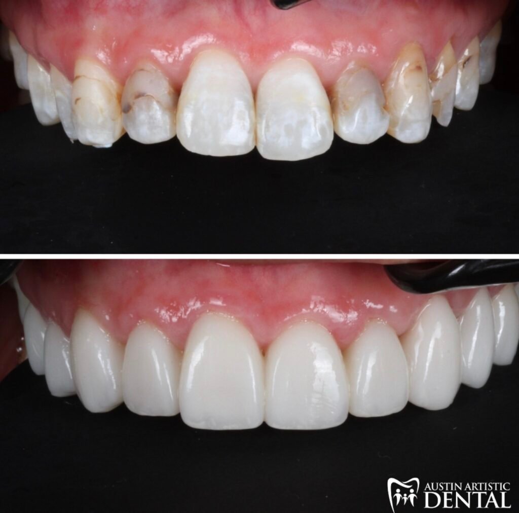 Porcelain Veneers to restore large cavities