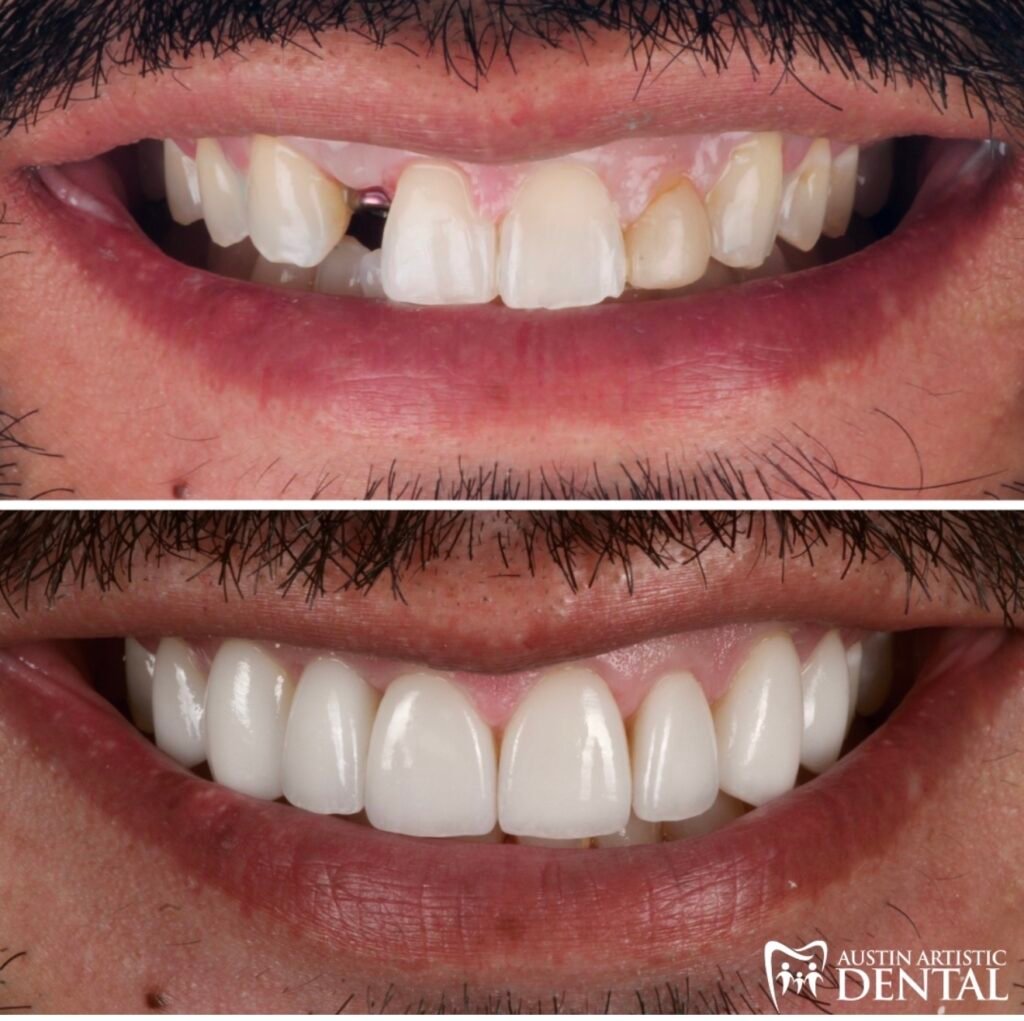 porcelain veneers and implants