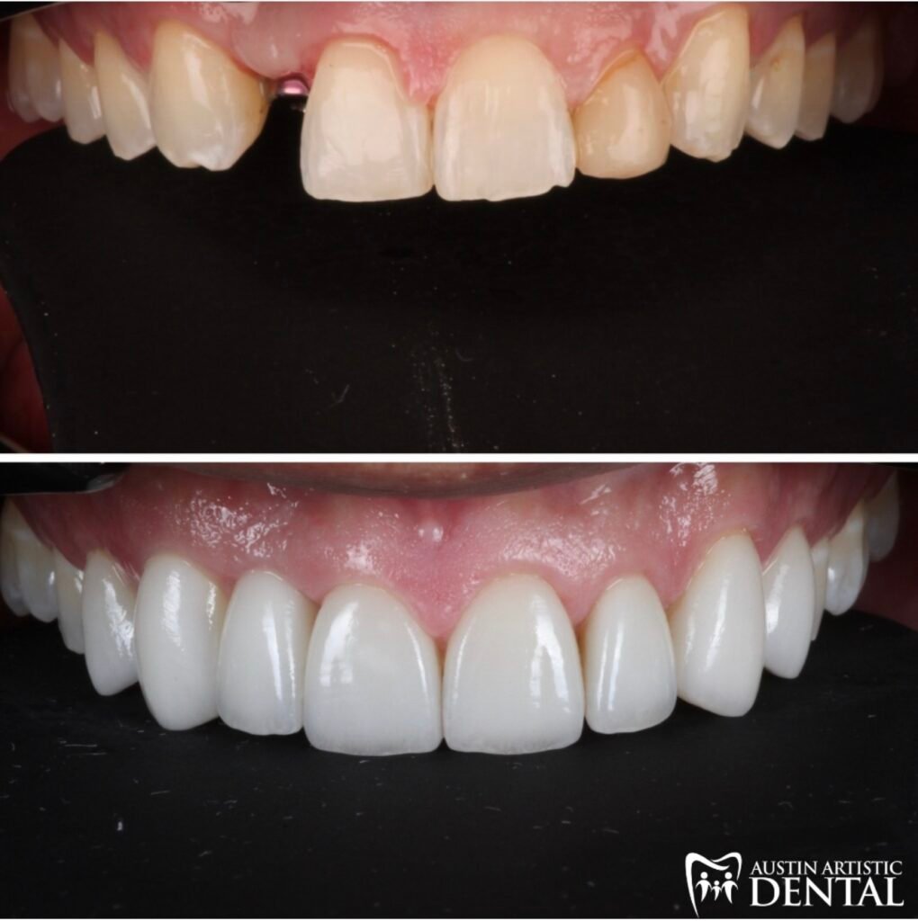 porcelain veneers and implants