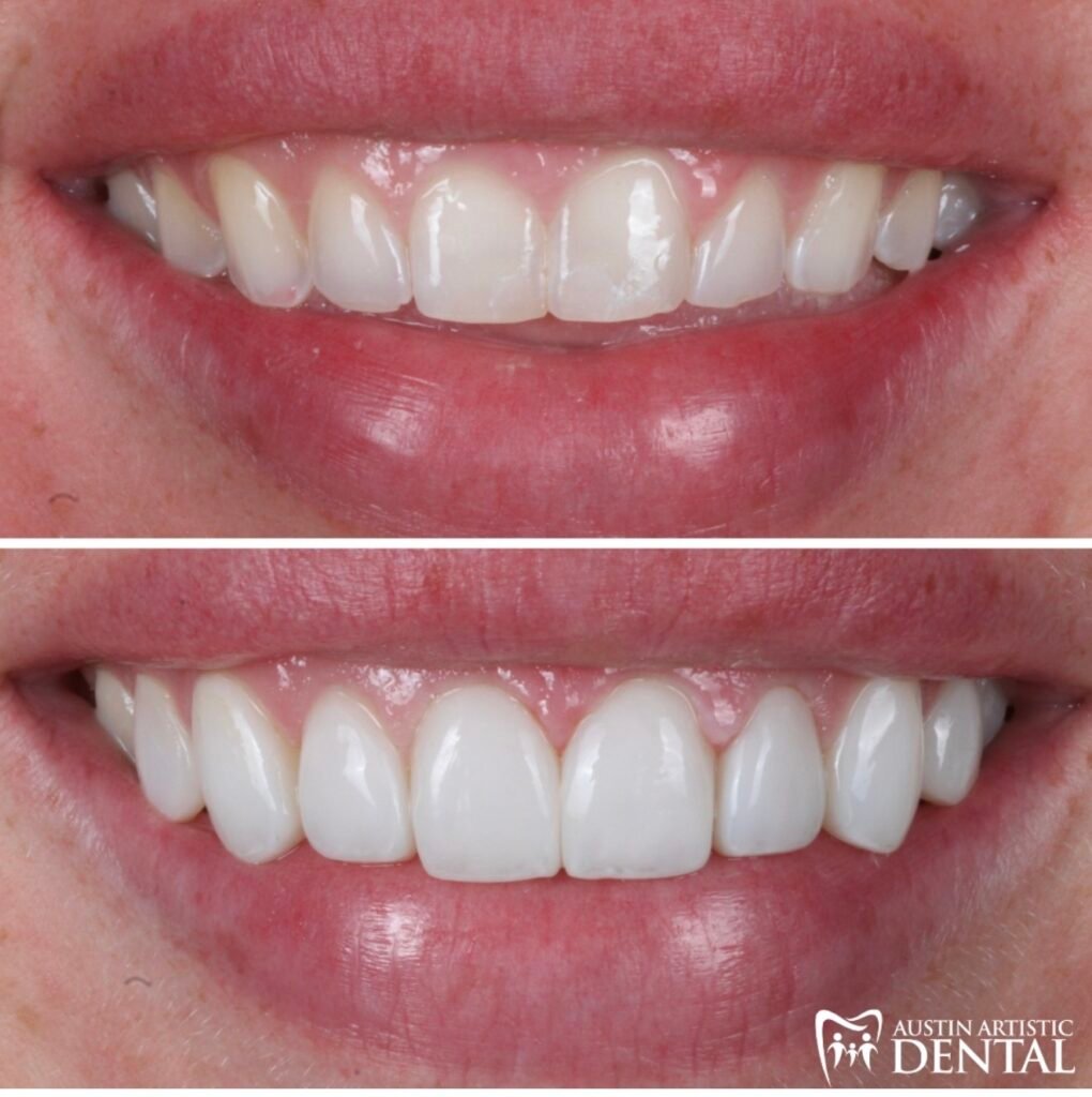 Highlight Composite Veneers
