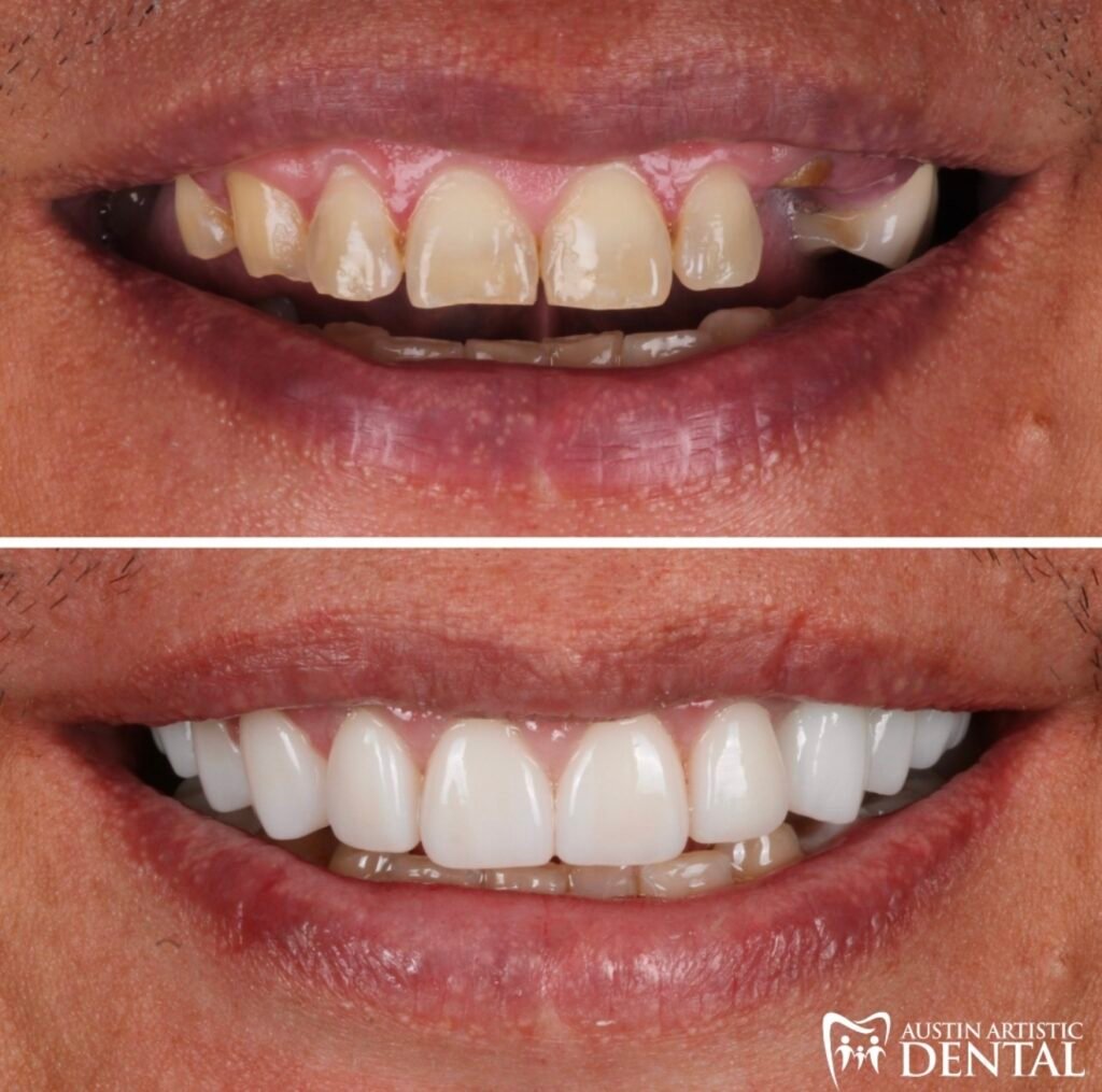 Porcelain Veneers with Dental Implants