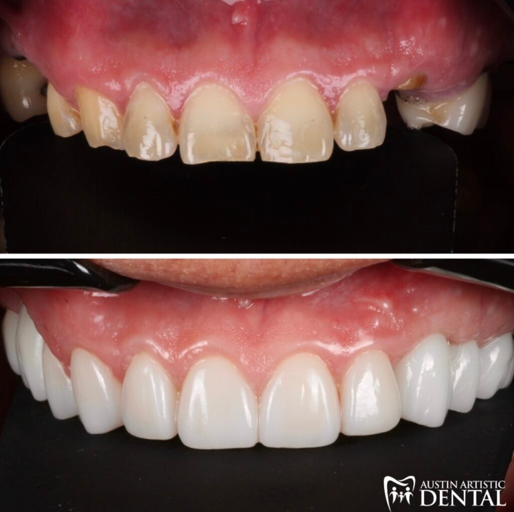 Porcelain Veneers with Dental Implants