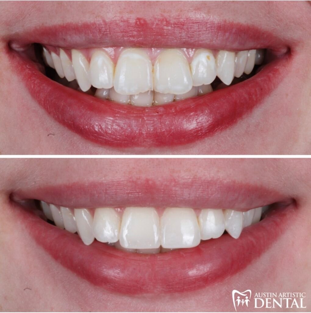 Highlight Composite Veneers for chipped teeth