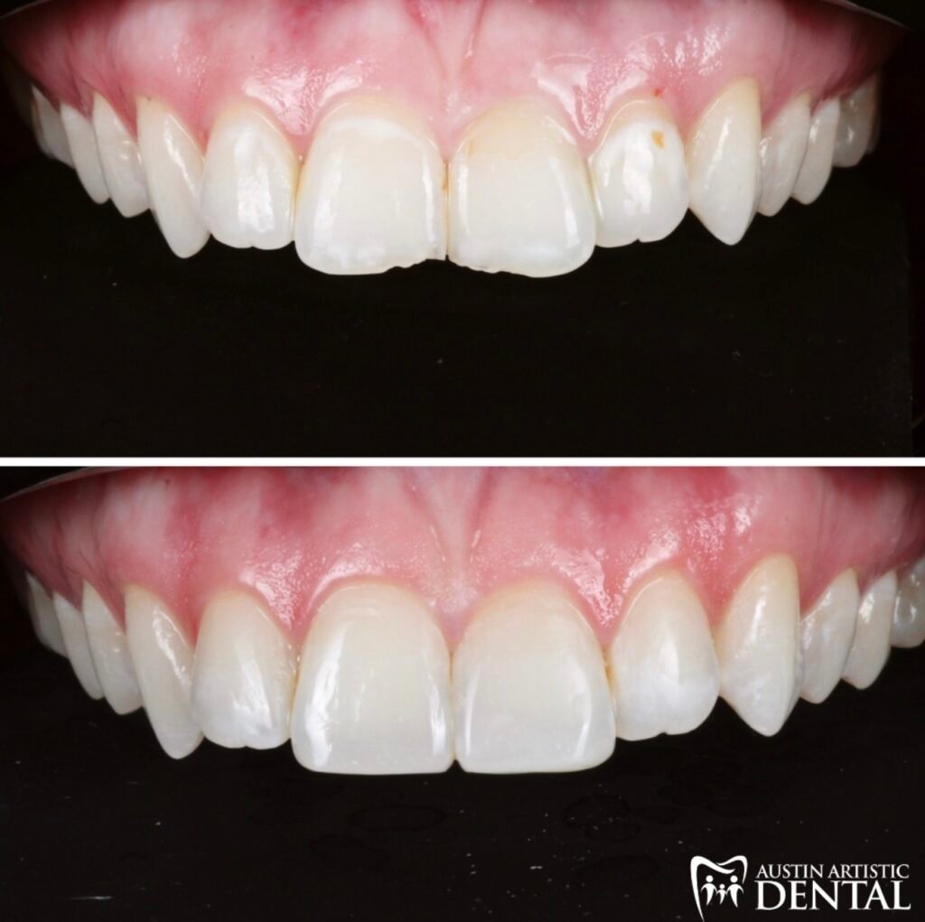 Highlight Composite Veneers for chipped teeth