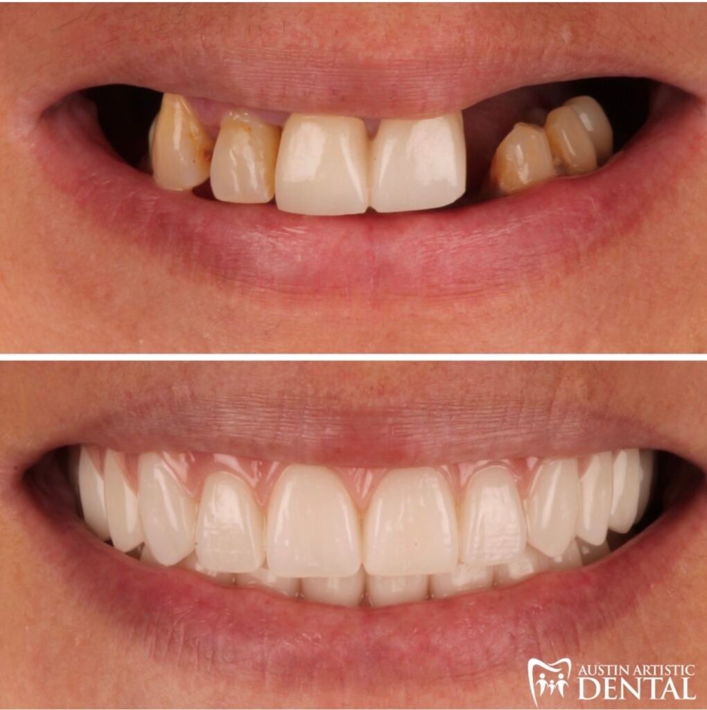 Cosmetic Denture