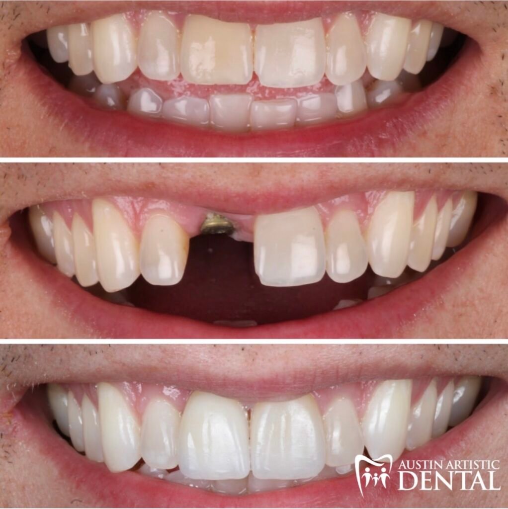 Front Tooth lost by internal resorption