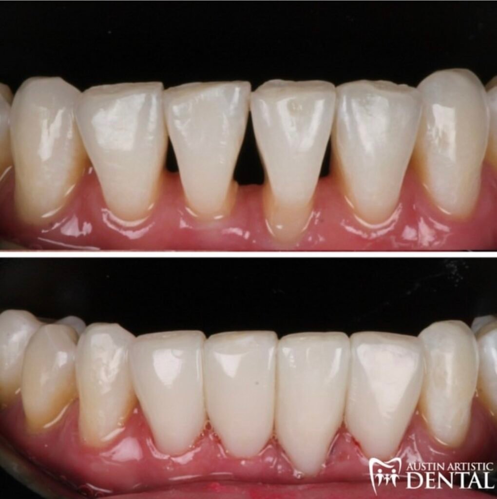 Bioclear Black Triangle Closure