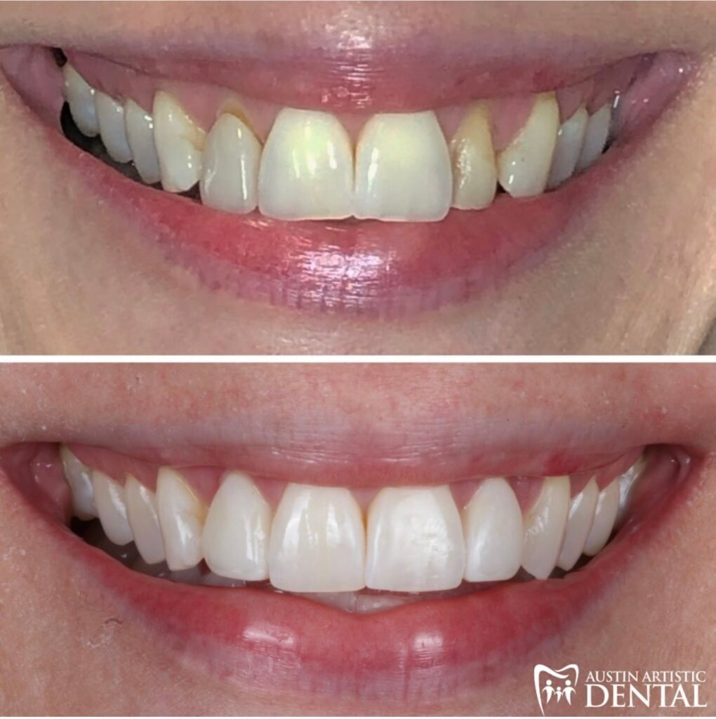 Highlight composite Veneers to replace porcelain veneers