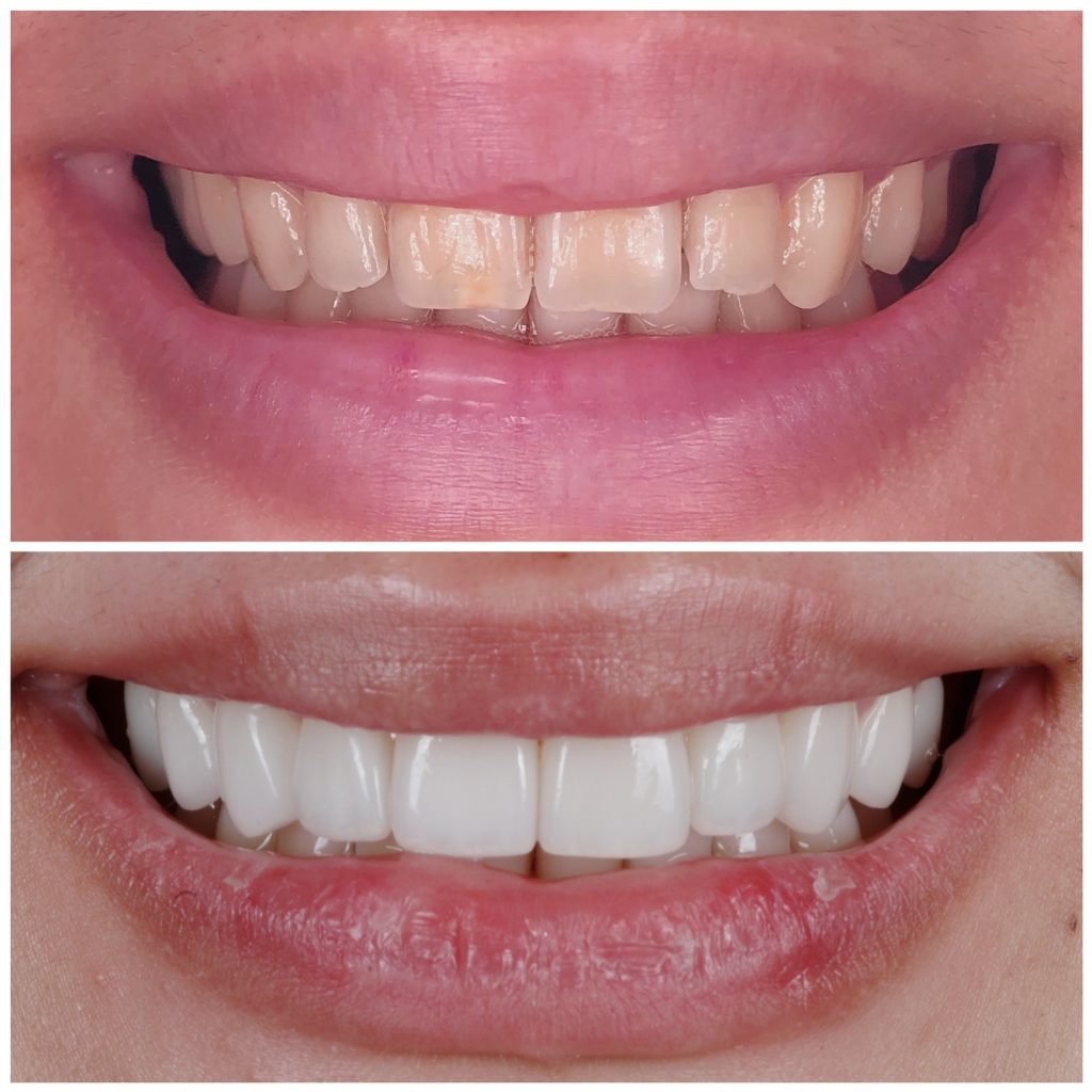 no shave veneers