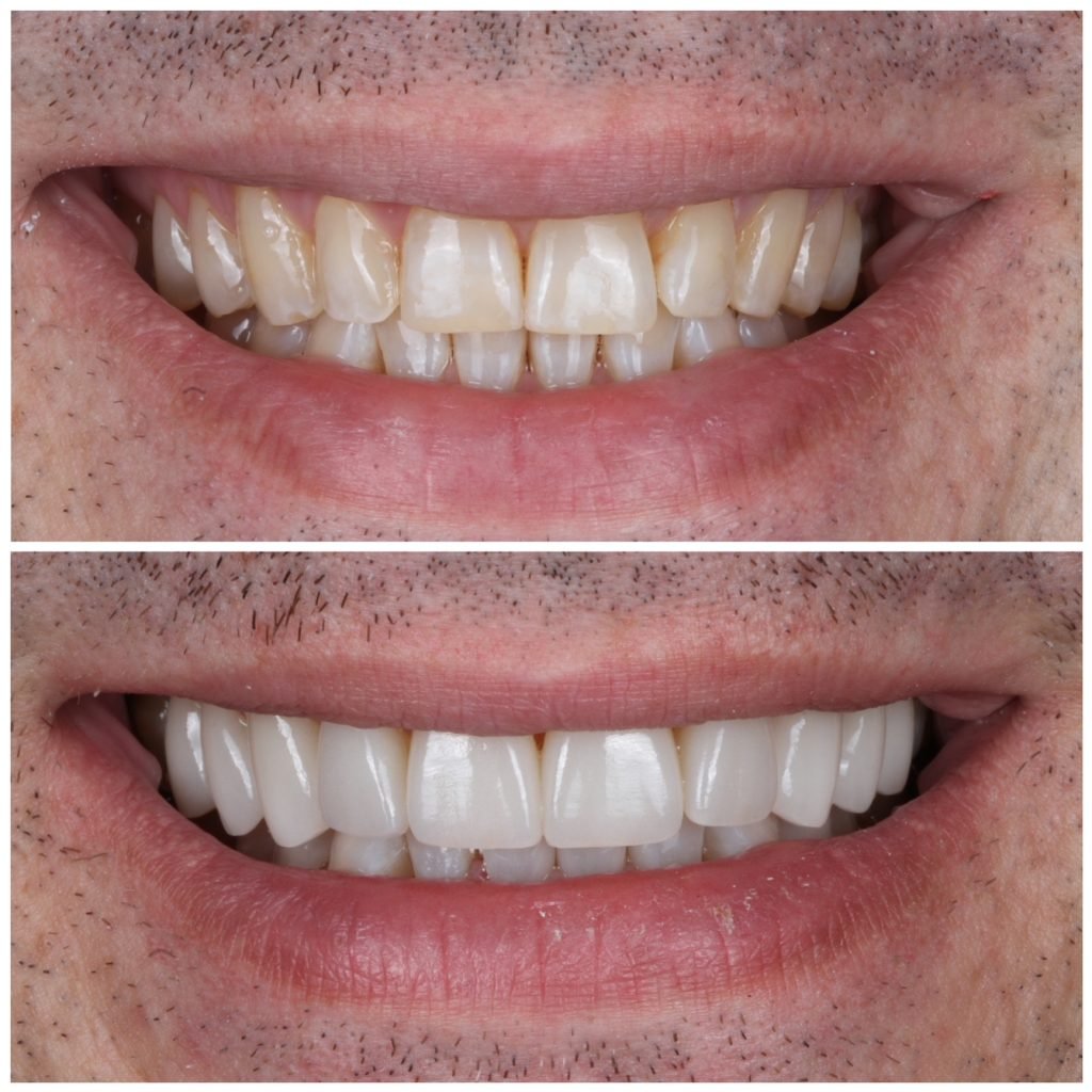 Natural looking Smile makeover