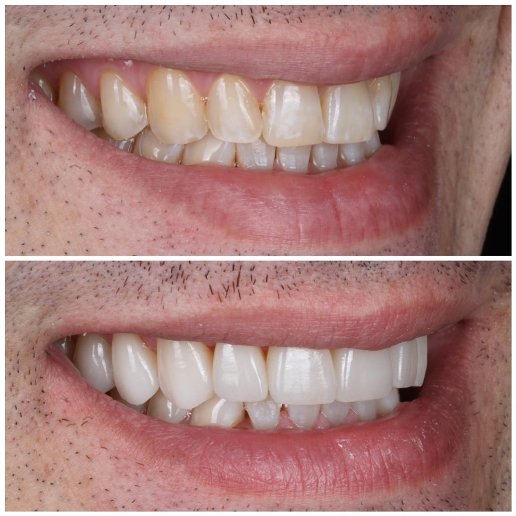 Porcelain Veneer Smile Makeover